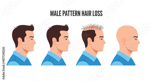 Educational diagram showing the four stages of male pattern hair loss from full hair to a completely bald head.