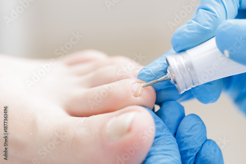 Φωτογραφία Podiatrist performing nail treatment on patient foot with precision tools