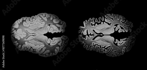 Healthy and Alzheimer Brain Axial Comparison on Black