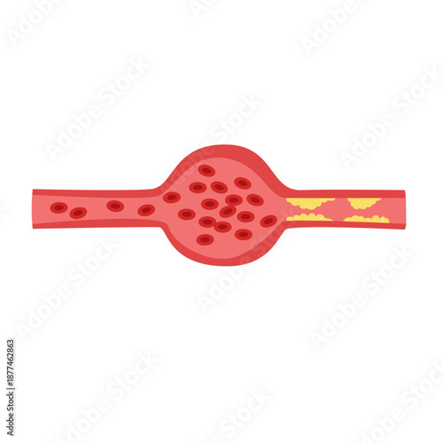 Cholesterol Buildup in Blood Vessel concept