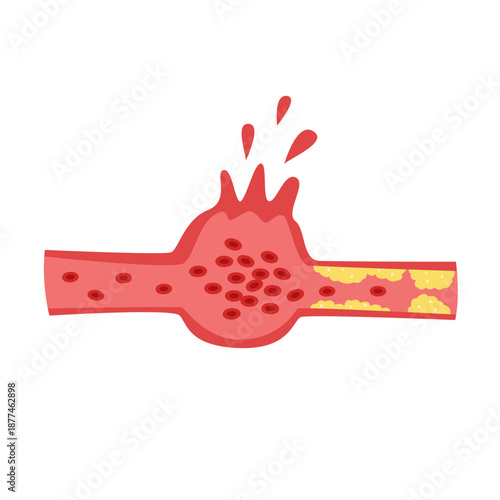 Cholesterol Buildup in Blood Vessel concept