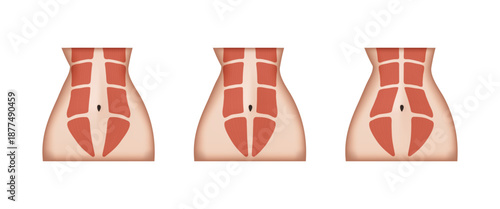 Different stages of diastasis recti showing abdominal muscles separation
