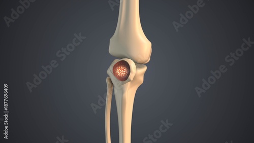 Photos Malignant involvement of the patella