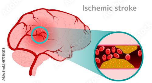 Ischemic strokes happen when a blood clot blocks a blood vessel in your brain. Cross section. Illustration vector