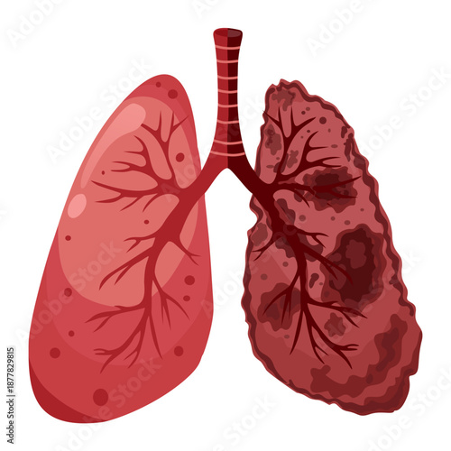 Lung Infection Illustration