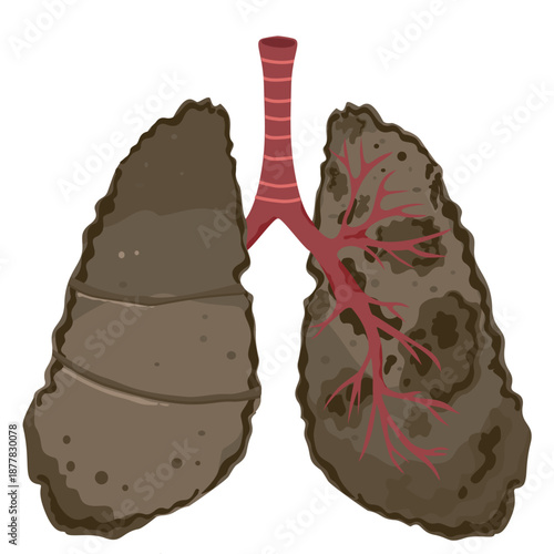 Smoker Lungs Front View