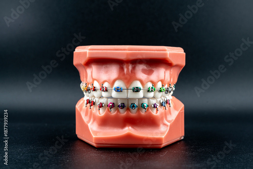 Tableau sur toile Orthodontic dental model with colorful metal braces on black background