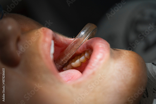 Canvastavla use of a saliva ejector suction tube during a dental treatment