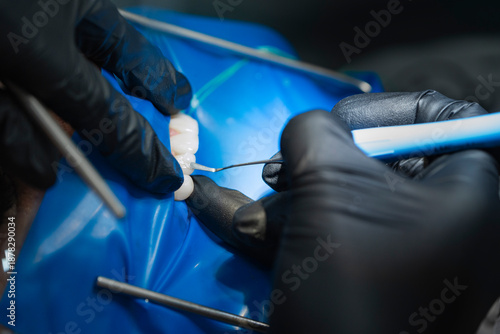 Close-up of a dentist using a dental probe for tooth restoration with rubber dam
