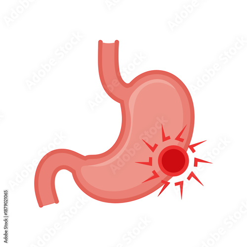 Illustration of stomach with ulcer pain in red tones