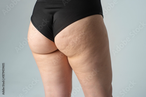 Woman with cellulite. Cellulite thigh fat skin texture. Young woman with cellulite problem. Cellulite and cosmetic concept.