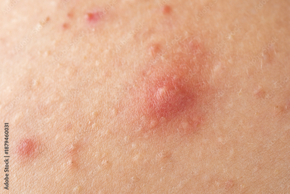 Fototapeta premium Pimple macro closeup on inflamed skin. Pimples closeup detail for dermatology. Pimple macro texture on skin. Skin problem. Acne closeup. Acne oily skin in puberty. Dermatology concept.
