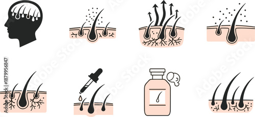 Hair loss and regrowth treatment illustration set showing scalp follicles, serum application, and growth process