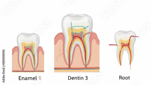 Detailed illustration of human tooth anatomy and decay.