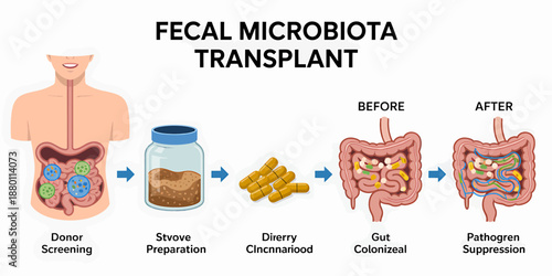 Fecal Microbiota Transplant Process Infographic Illustration