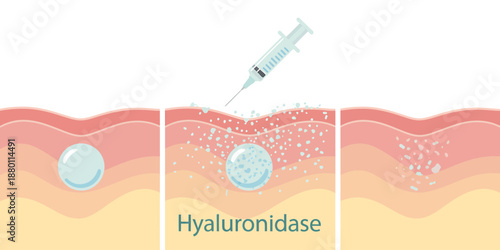 Hyaluronidase injection process illustrated medical diagram
