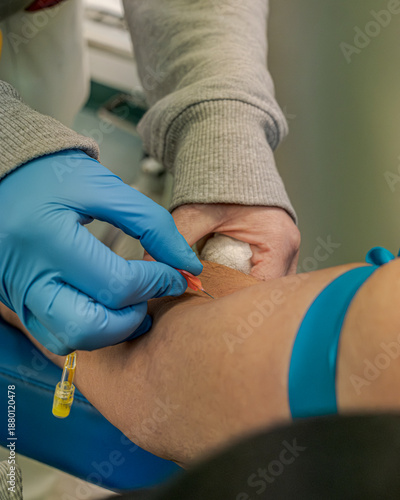 Subjective image at the moment of penetration of the butterfly needle into the skin of the oncology patient who is about to undergo a PET scan. Bologna, Italy
