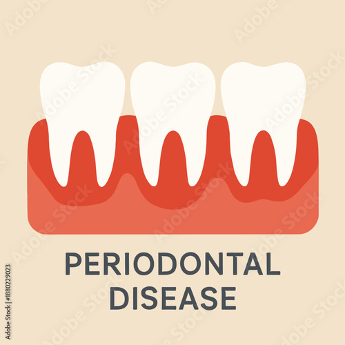 Inflamed gums and gingivitis medical vector