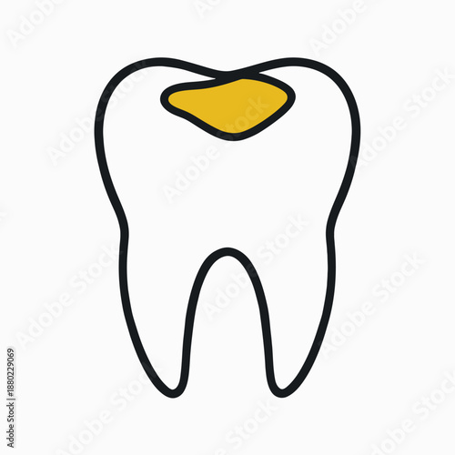Tooth with gold filling restoration