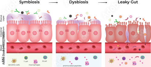 Gut Health Progression From Symbiosis to Dysbiosis and Leaky Gut