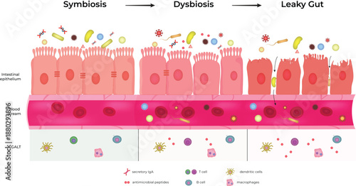 Gut Health Progression From Symbiosis to Leaky Gut Syndrome