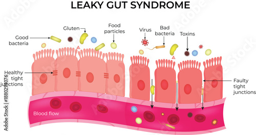 Leaky Gut Syndrome Explained Intestinal Permeability and Gut Health