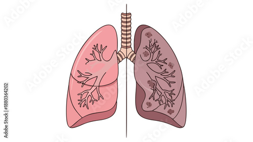Detailed anatomical illustration of human lungs with trachea and bronchi shown in a medical diagram view