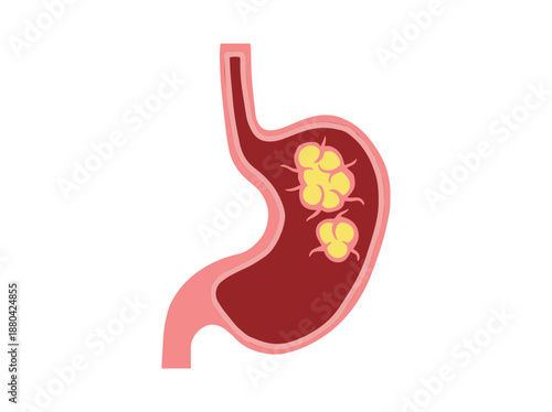 Stomach Cancer Disease Illustration
