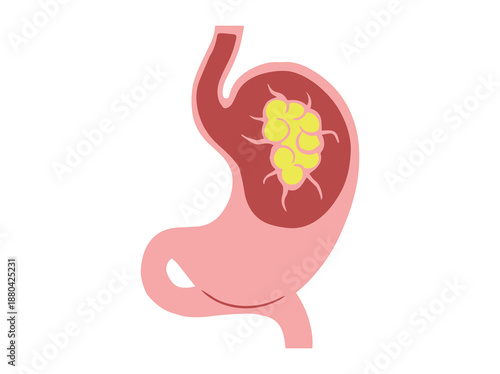 Stomach Cancer Disease Illustration
