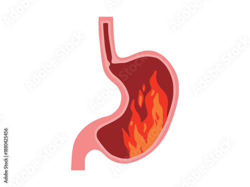 Stomach Burning or Heartburn Disease
