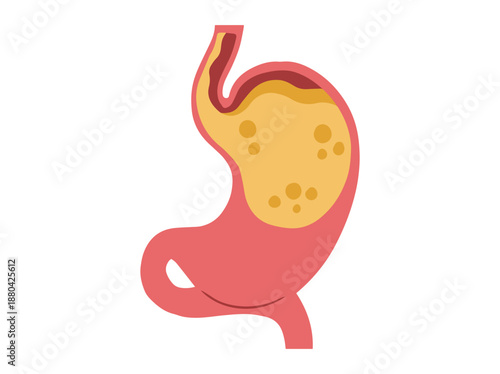 Gastroesophageal Reflux Disease in Stomach