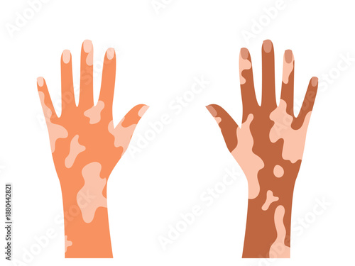 Human Hand Vitiligo, skin disease, self care and self love