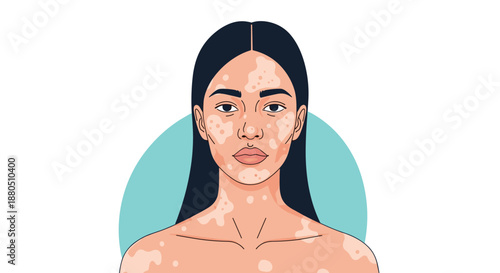 Beautiful portrait illustration of a young woman with vitiligo skin condition on a light blue circular background element.