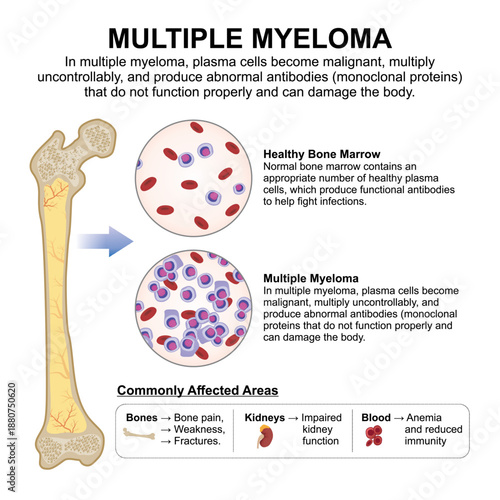 Multiple Myeloma Bone Medical Flashcard