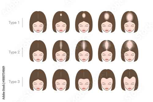 Cartoon-style chart showing three types of female pattern hair loss with scalp diagrams.