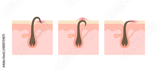 Human skin cross section with hair follicle anatomy showing epidermis, dermis, glands and blood vessels, medical diagram.