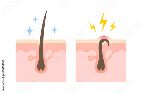 Human skin cross section with hair follicle anatomy showing epidermis, dermis, glands and blood vessels, medical diagram.