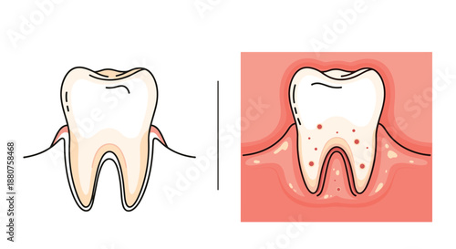 Comparison between a healthy tooth with pink gums and a diseased tooth showing signs of inflammation, infection, and red spots.
