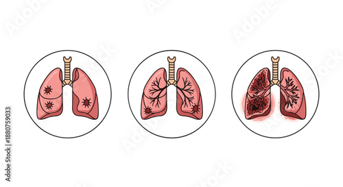 Comparison of human lung stages showing healthy respiratory organs progressing to severe disease and inflammation for medical education and awareness.