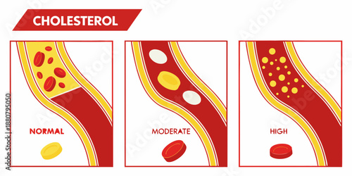 Comparison of normal, moderate and high cholesterol levels in artery