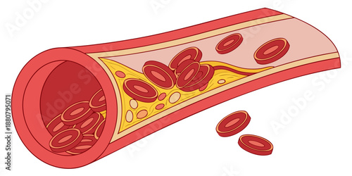 Artery with plaque buildup and red blood cells illustration