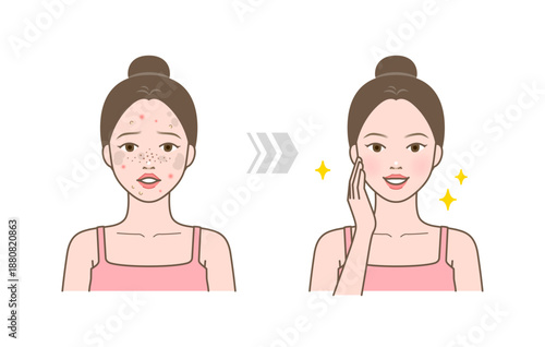 Female face before and after skincare showing acne, spots and blemishes improving to smooth, clear and glowing skin.