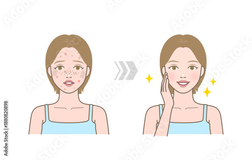 Female face before and after skincare showing acne, spots and blemishes improving to smooth, clear and glowing skin.