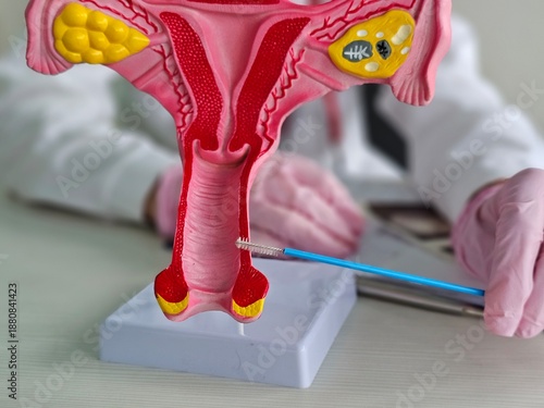 A gynecologist using a model of the female uterus to take gynecological smears to determine and characterize the microflora of the urogenital tract.