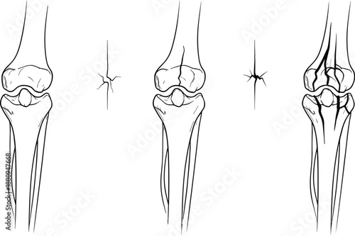 Knee joint anatomy line art illustration showing bone structure, injury points, and orthopedic medical diagram in vector outline style
