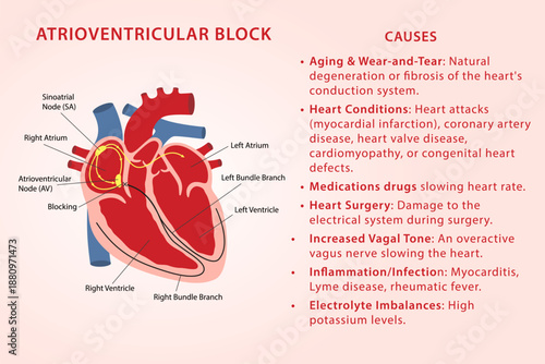 Causes of Atrioventricular Block. Medical illustration of diseased heart and description of the main causes of atrioventricular block. Vector illustration in flat style, isolated on a white background