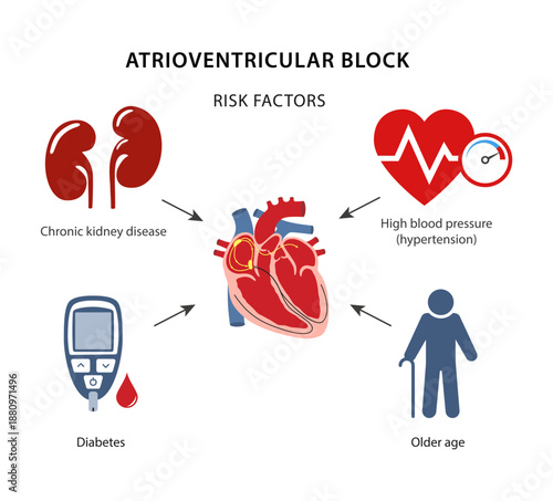 Risk factors for atrioventricular block: hypertension, diabetes, chronic kidney disease and older age. Medical illustration. Vector illustration in flat style, isolated on a white background.