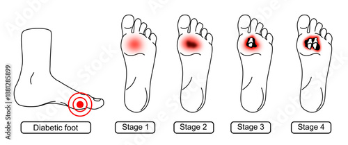 Diabetic foot syndrome stages. Foot wounds, deep ulcers, open wounds. Inflammation, infection, and amputation. Line drawing Vector illustration for medical, diagnostic, and education.