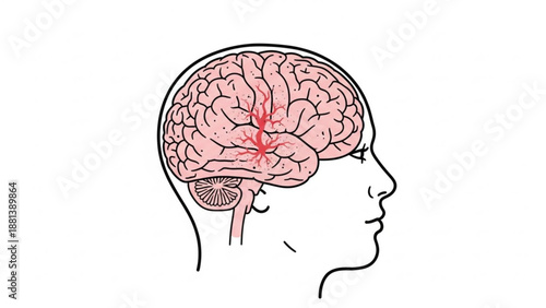 A medical illustration of a human brain with a highlighted area of damage