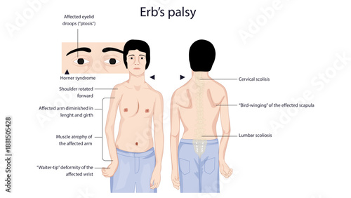 Erbs palsy
Erb’s palsy is an upper brachial plexus injury that usually occurs due to damage to the C5–C6 nerve roots.
It most commonly happens after birth trauma (shoulder dystocia) or after trauma in